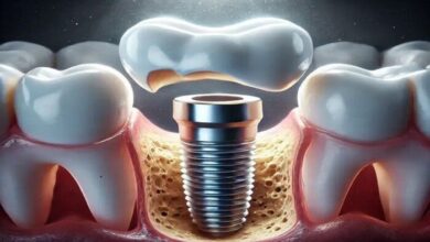 فراخوان مشارکت در فناوری دستیابی به دانش فنی ایمپلنت‌های اختصاصی