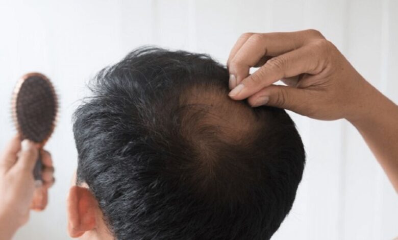 ریزش سکه‌ای مو/ وقتی بدن علیه موهای خودش وارد جنگ می‌شود