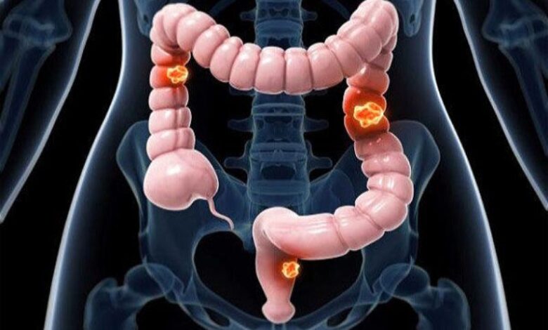 نوآوری پژوهشگر ایرانی برای مبارزه با سرطان روده بزرگ