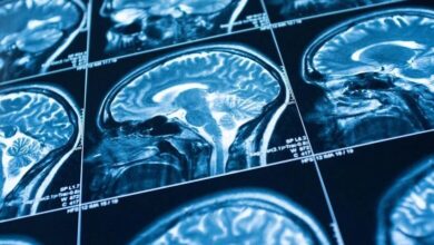 حجم مغز افراد روان‌آزار کمتر است