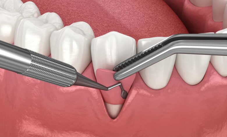 راهکار نانویی برای تسریع ترمیم و کاهش خطر عفونت جراحی دندان