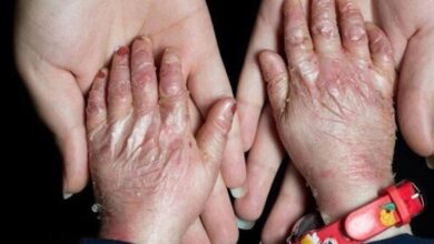 ۹۵ درصد بیماران «ای بی» حاصل ازدواج فامیلی/ امکان تشخیص پیش از تولد وجود ندارد